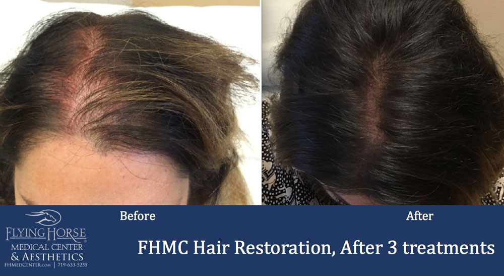 Hair Restoration Treatment Colorado Springs