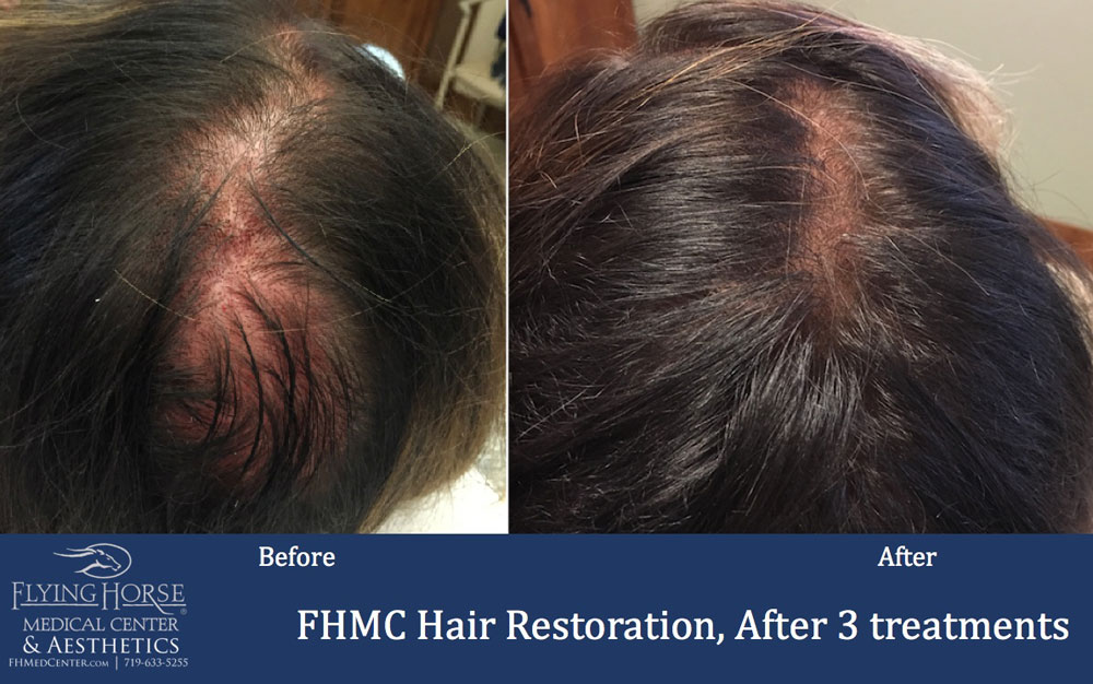 FHMC Hair Restoration Treatment Service