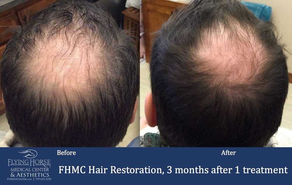 FHMC Hair Restoration Treatment Service Monument