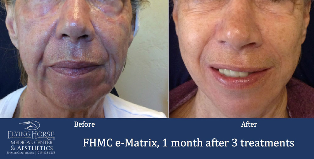 FHMC E-matrix Services 1 Months After 3 Treatment