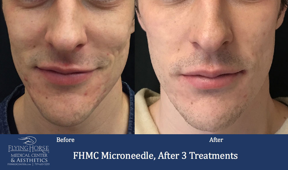 FHMC Microneedling, After 3 Treatments