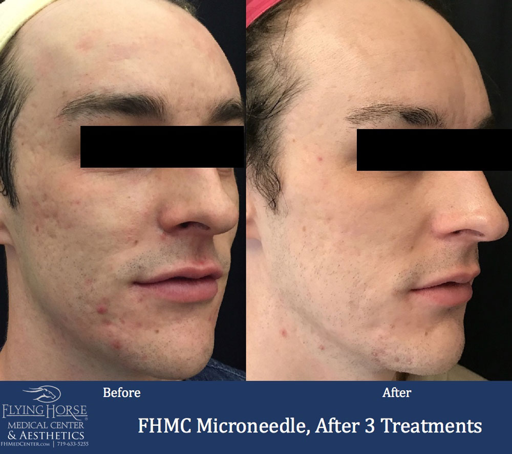 FHMC Microneedling Services, After 3 Treatment