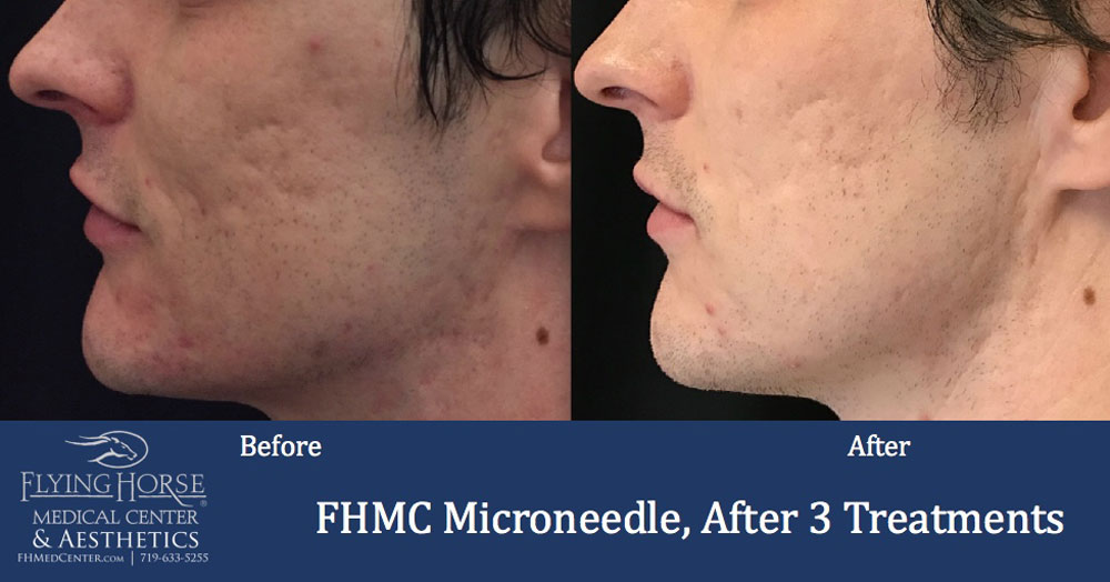 FHMC Microneedling Services, 1 Months After 3 Treatment