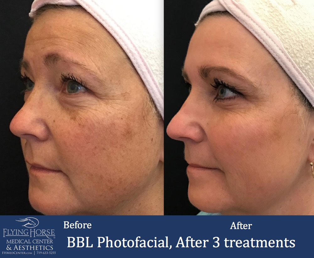 FHMC BBL Photofacial, After 3 Treatment