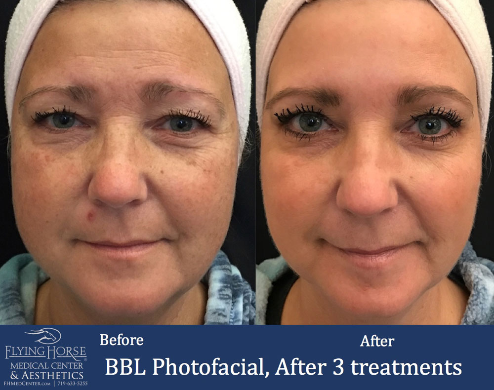 FHMC BBL Photofacial Treatment