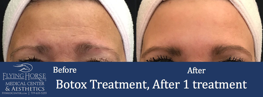 FHMC Botox, After 1 Treatment