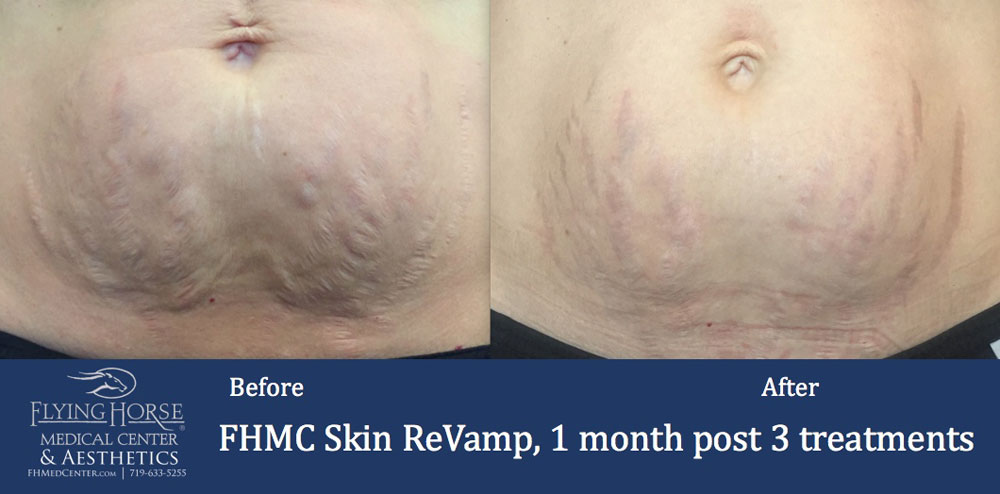 FHMC Skin ReVamp, 1 Months After 3 Treatment