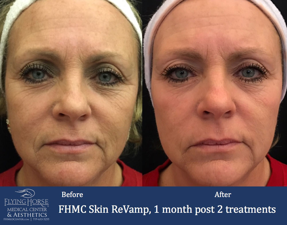 FHMC Skin ReVamp, 1 Months Post 2 Treatment