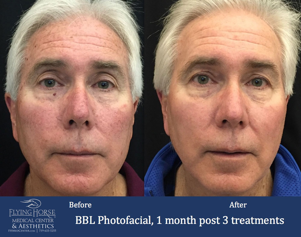 FHMC BBL Photofacial, 1 Months Past 3 Treatment