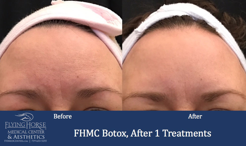 FHMC Botox Services, After 1 Treatment