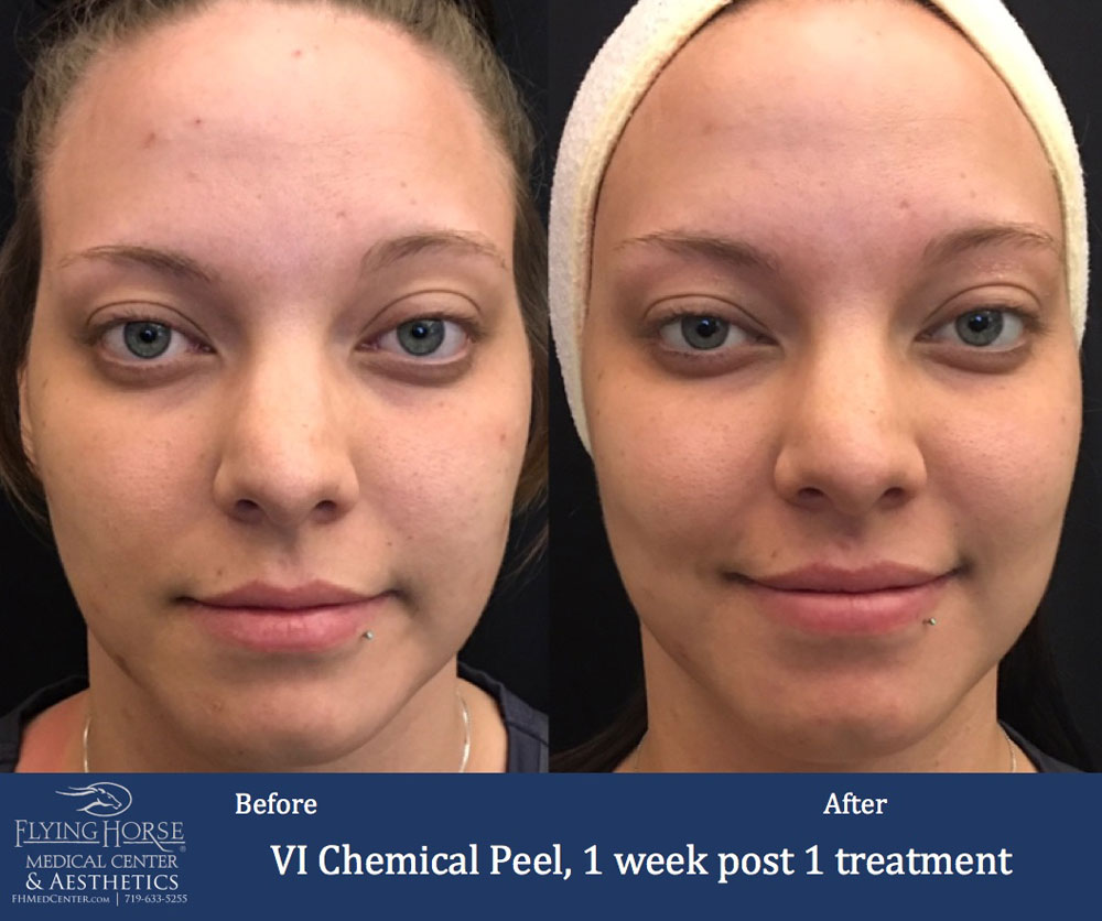 FHMC VI Chemical Peels, 1 Week Post 1 Treatment