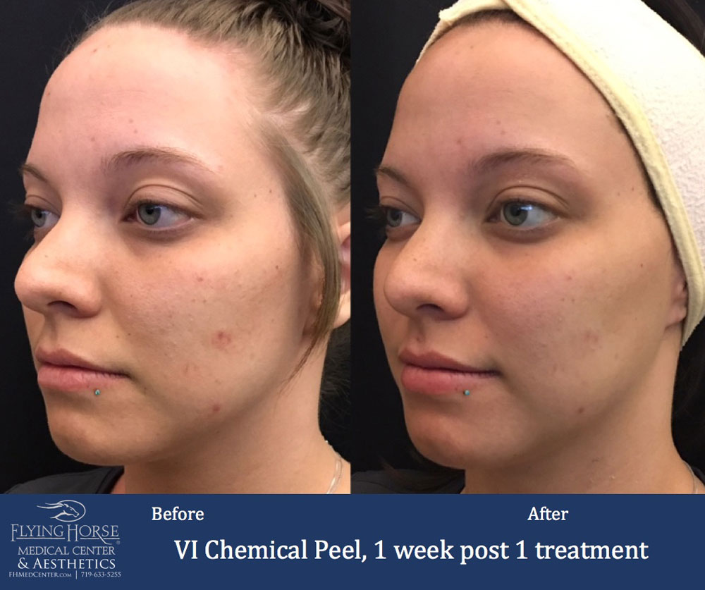 FHMC Chemical Peels, 1 Week Past 1 Treatment