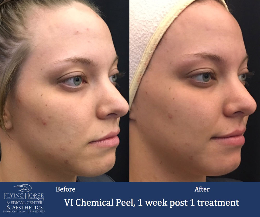 FHMC VI Chemical Peels Services, 1 Week Post 1 Treatment