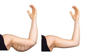 Brachioplasty (Arm Lift) - Plastic Surgery