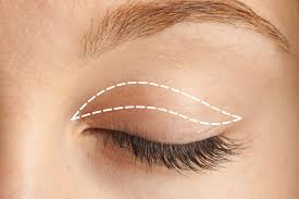 BLEPHAROPLASTY (UPPER) - Plastic Surgery