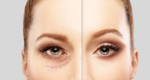 Blepharoplasty Upper-Plastic Surgery Flying Horse Medical Center