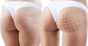 Brazilian Butt Lift- Plastic Surgery Flying Horse Medical Center