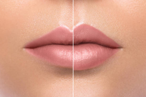 Fat Transfer to Lips-Plastic Surgery Flying Horse Medical Center