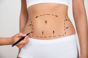 Liposuction-Plastic Surgery Flying Horse Medical Center Blog