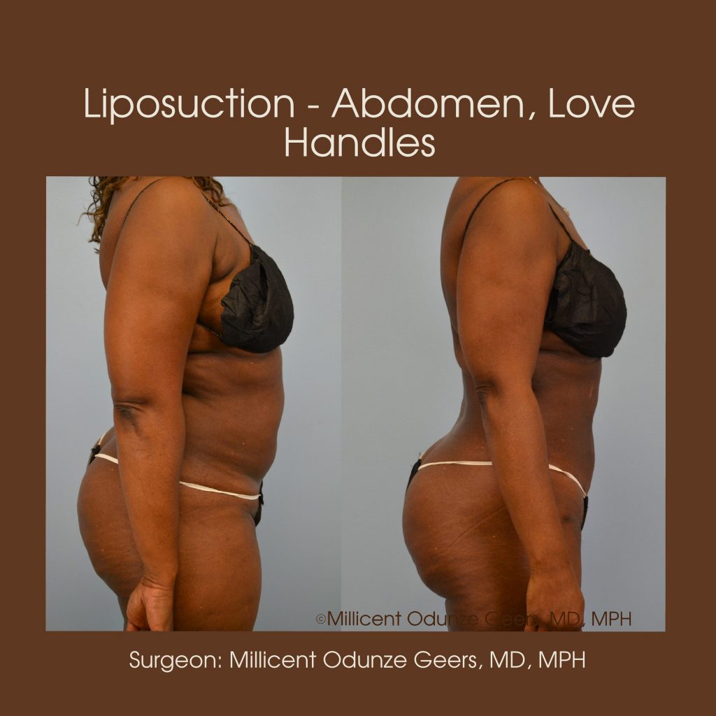 Best Colorado Springs Liposuction of Abdomen, Love Handles, Flanks