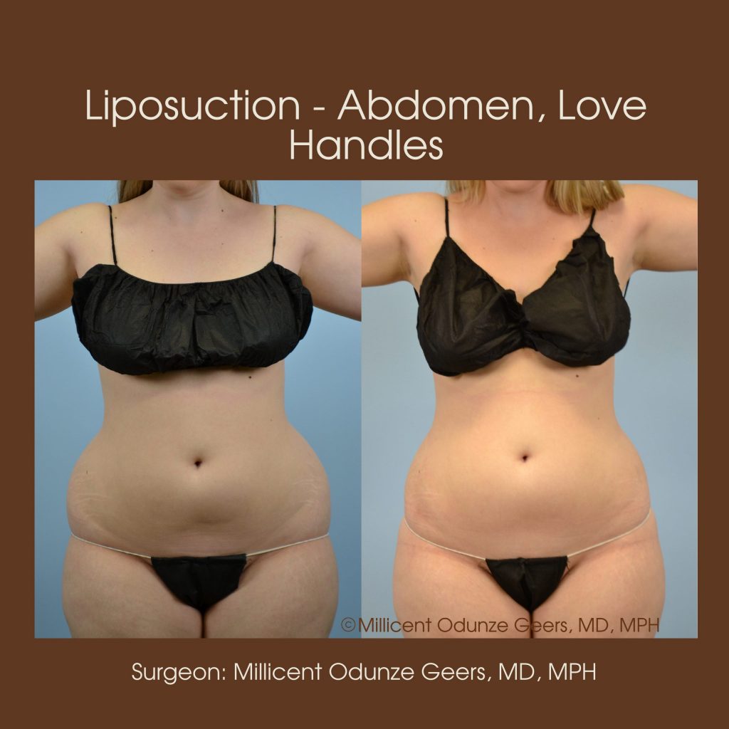 Best Colorado Springs Liposuction of Abdomen, Love Handles, Flanks