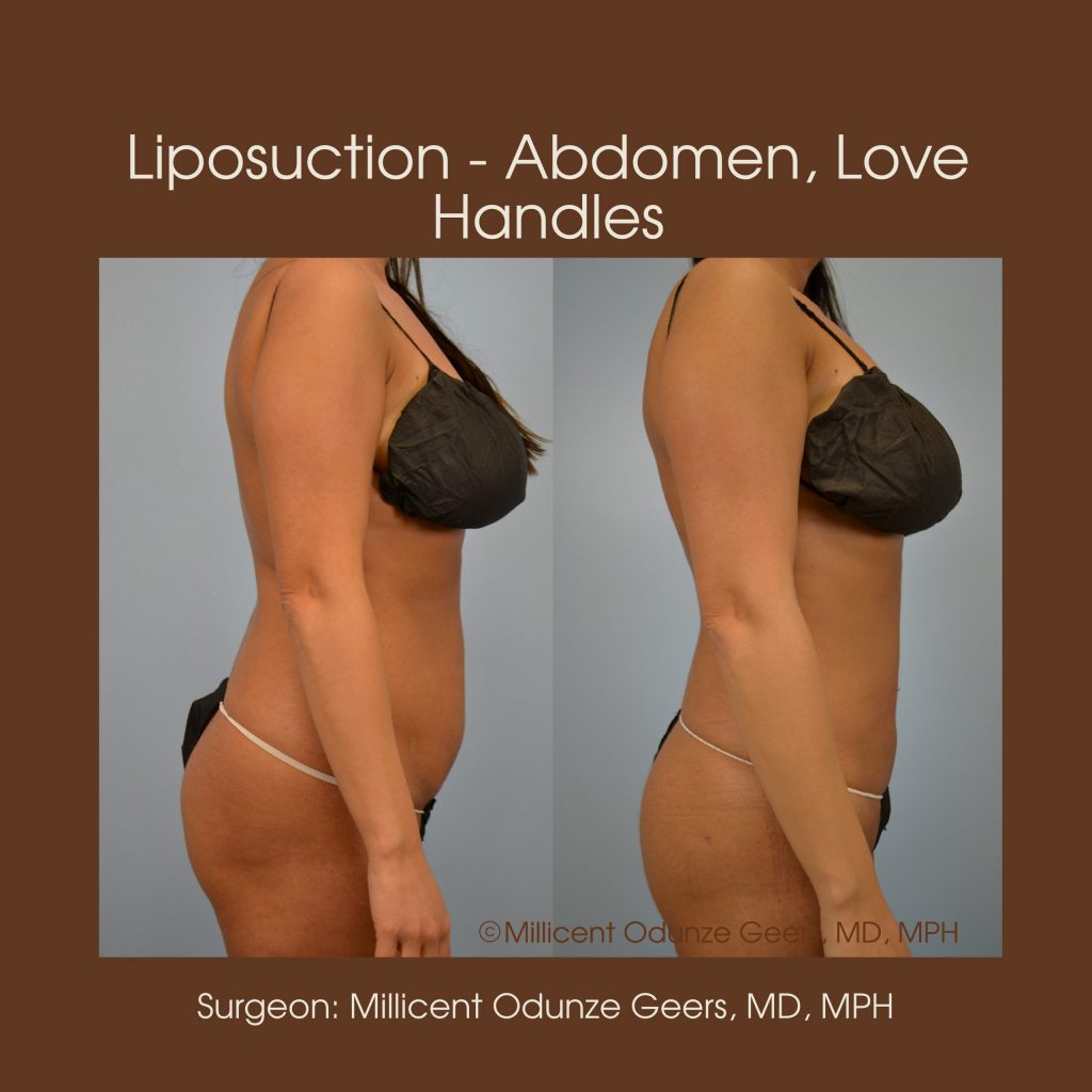 Best Colorado Springs Liposuction of Abdomen, Love Handles, Flanks