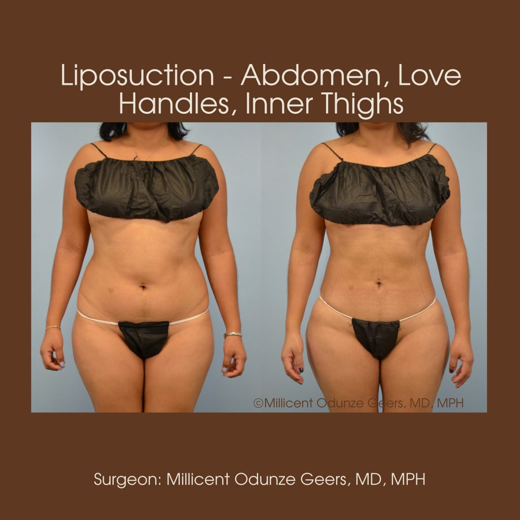 Best Colorado Springs Liposuction of Abdomen, Love Handles, Flanks