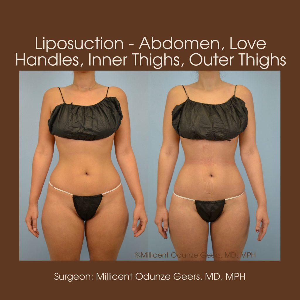 Best Colorado Springs Liposuction of Abdomen, Love Handles, Flanks