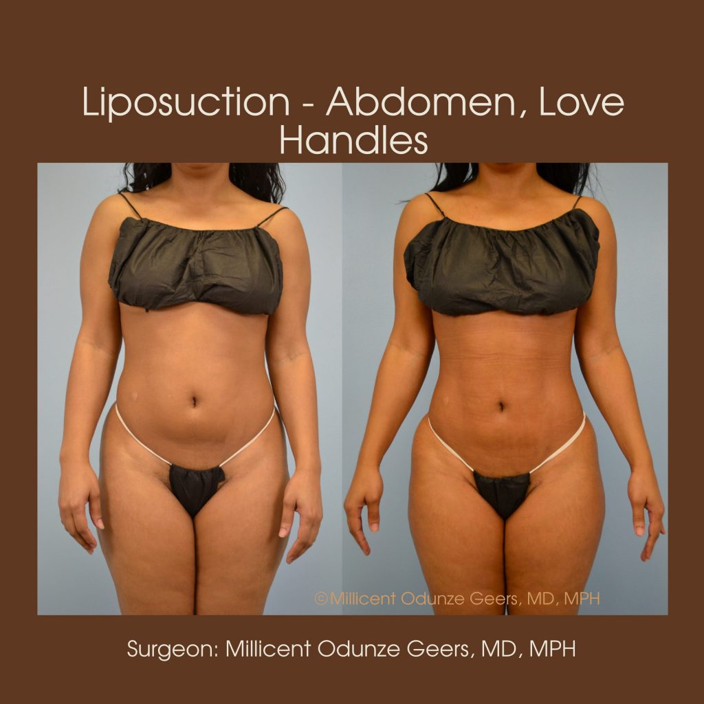 Best Colorado Springs Liposuction of Abdomen, Love Handles, Flanks