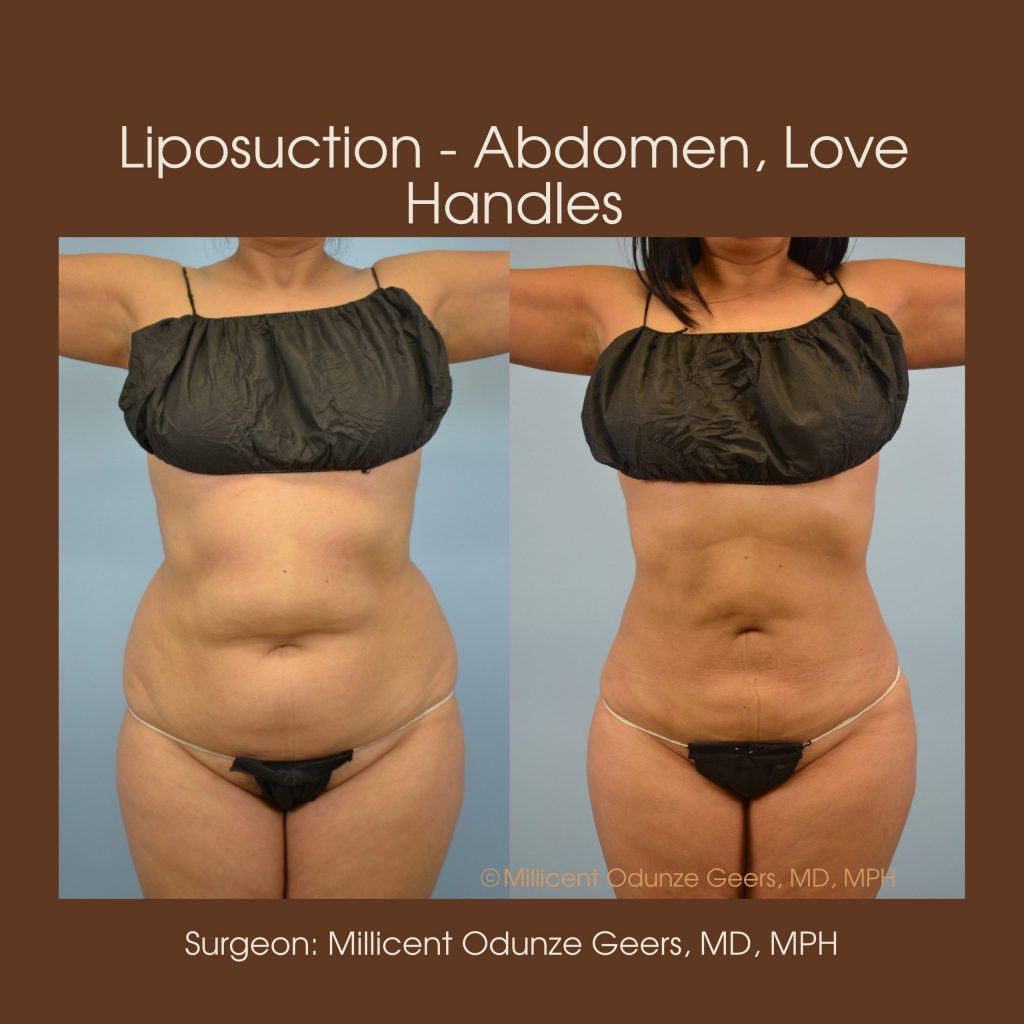 Best Colorado Springs Liposuction of Abdomen, Love Handles, Flanks, Waist