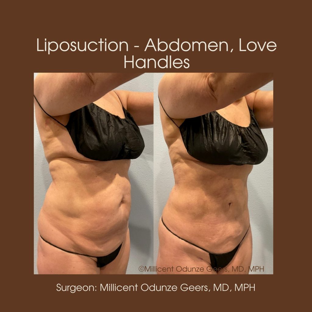 Best Colorado Springs Liposuction of Abdomen, Love Handles, Flanks