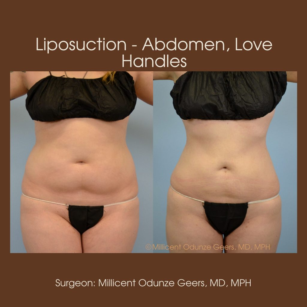 Best Colorado Springs Liposuction of Abdomen, Love Handles, Flanks, Waist