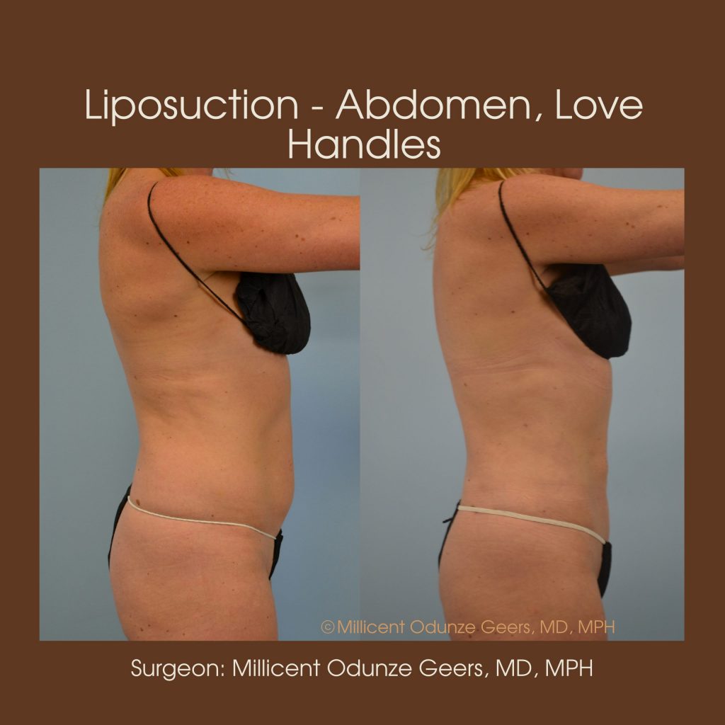 Best Colorado Springs Liposuction of Abdomen, Love Handles, Flanks