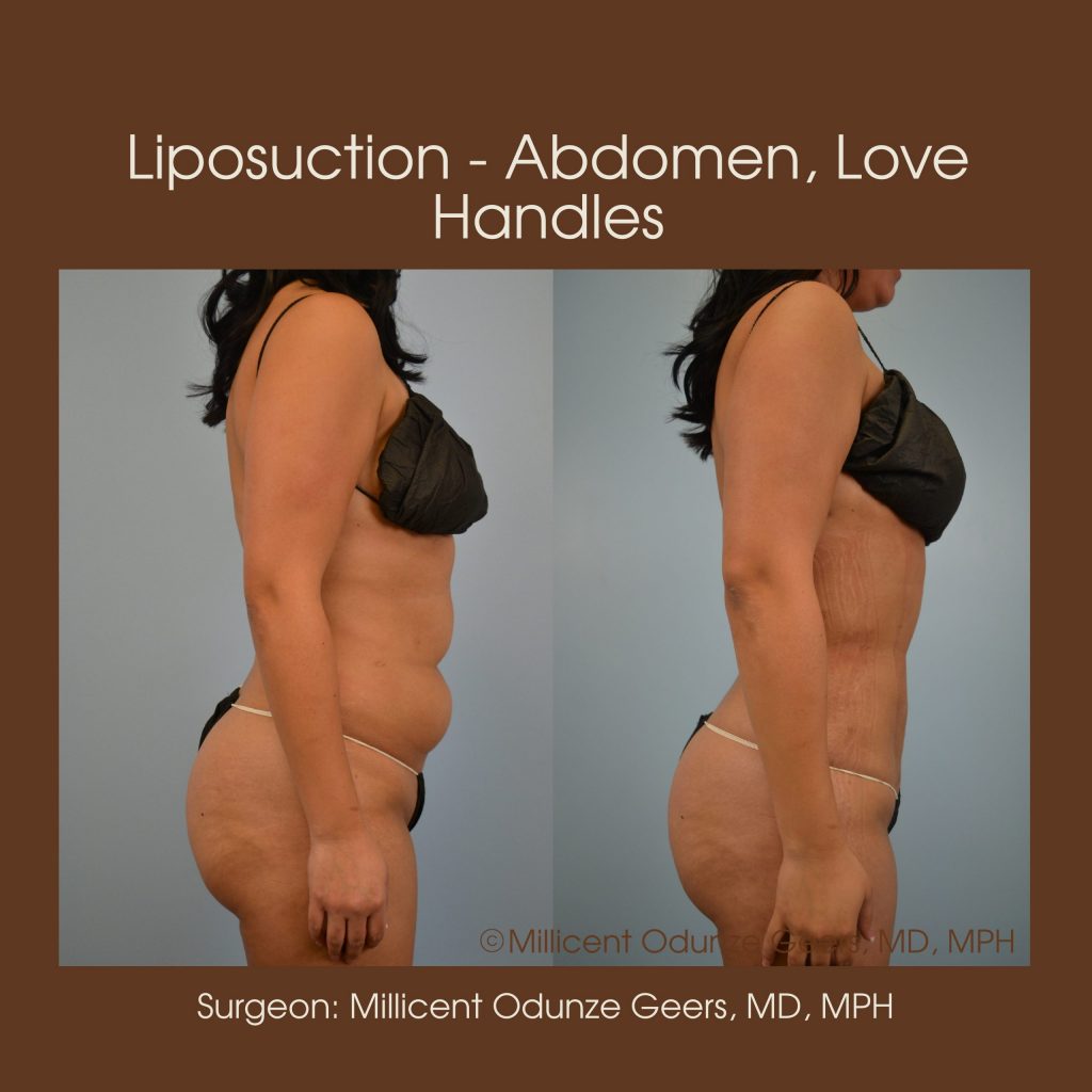 Best Colorado Springs Liposuction of Abdomen, Love Handles, Flanks