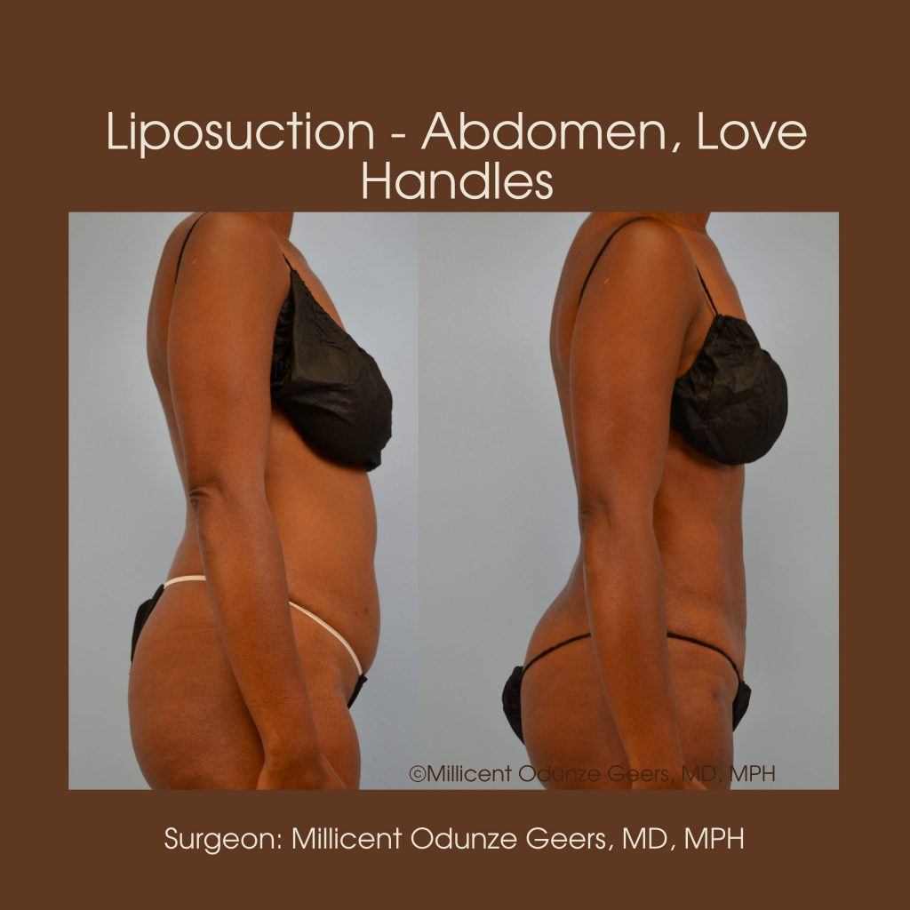 Best Colorado Springs Liposuction of Abdomen, Love Handles, Flanks, Waist