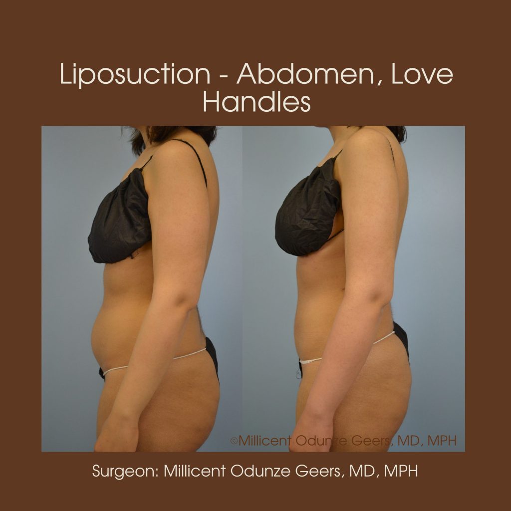 Best Colorado Springs Liposuction of Abdomen, Love Handles, Flanks