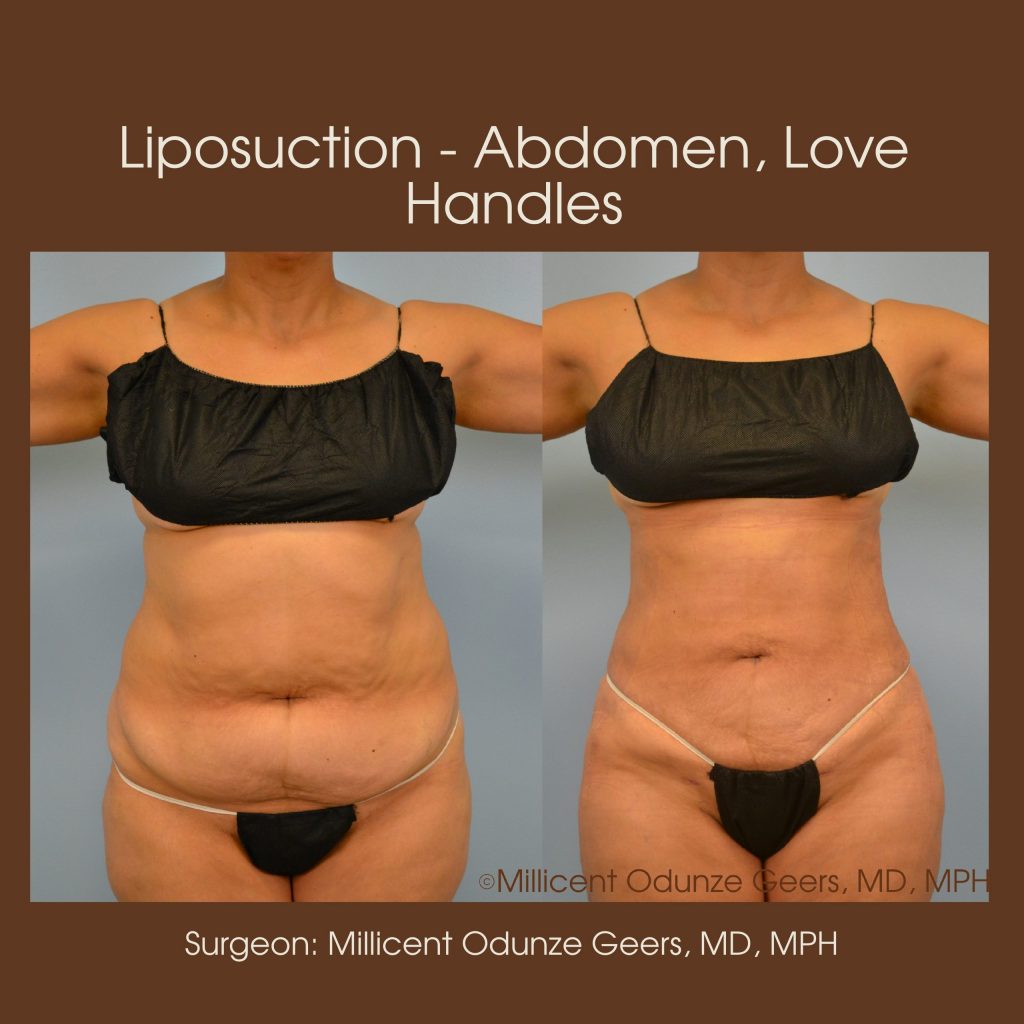 Best Colorado Springs Liposuction of Abdomen, Love Handles, Flanks, Waist