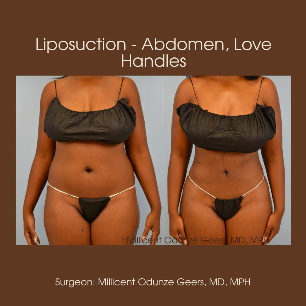 Best Colorado Springs Liposuction of Abdomen, Love Handles, Flanks, Waist