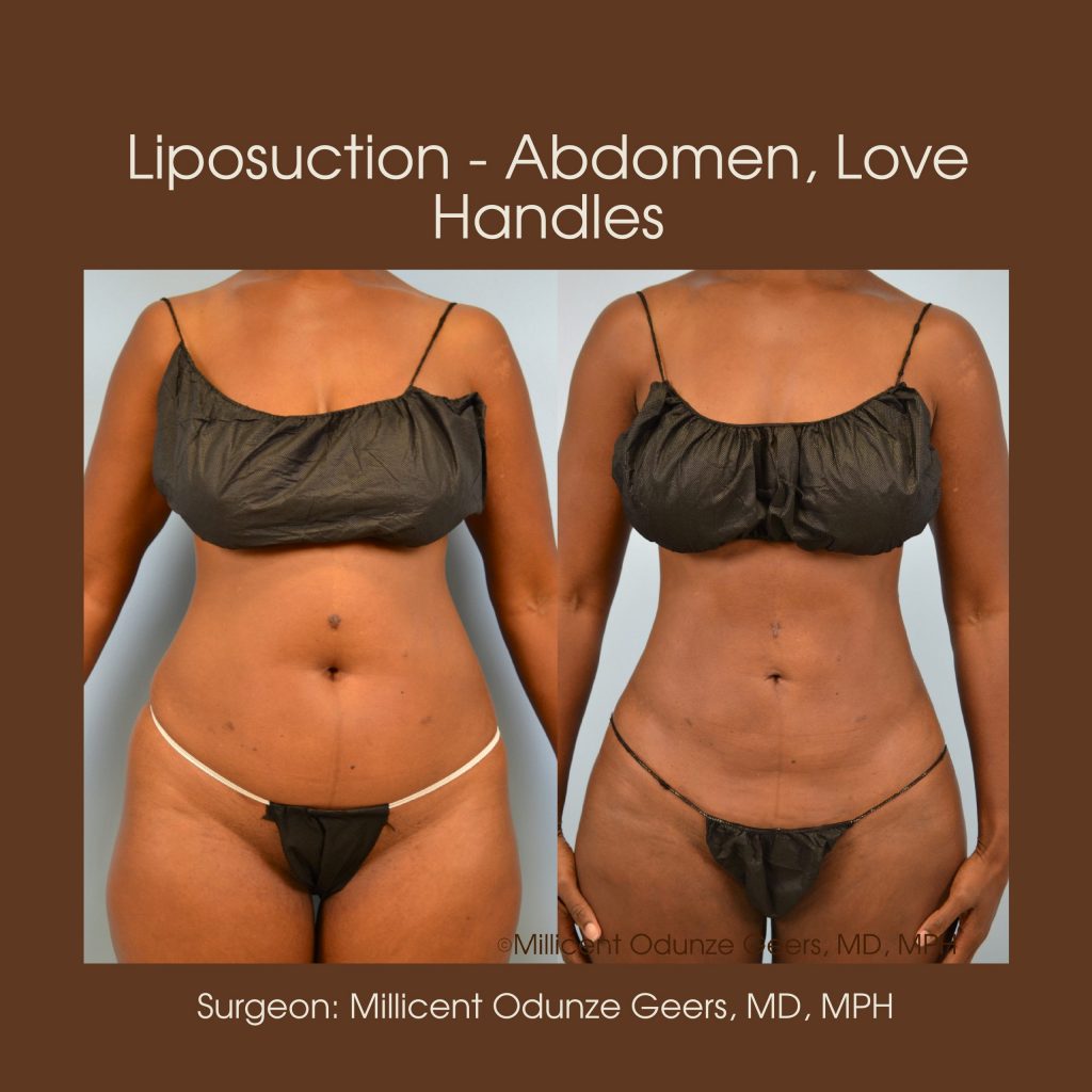 Best Colorado Springs Liposuction of Abdomen, Love Handles, Flanks, Waist