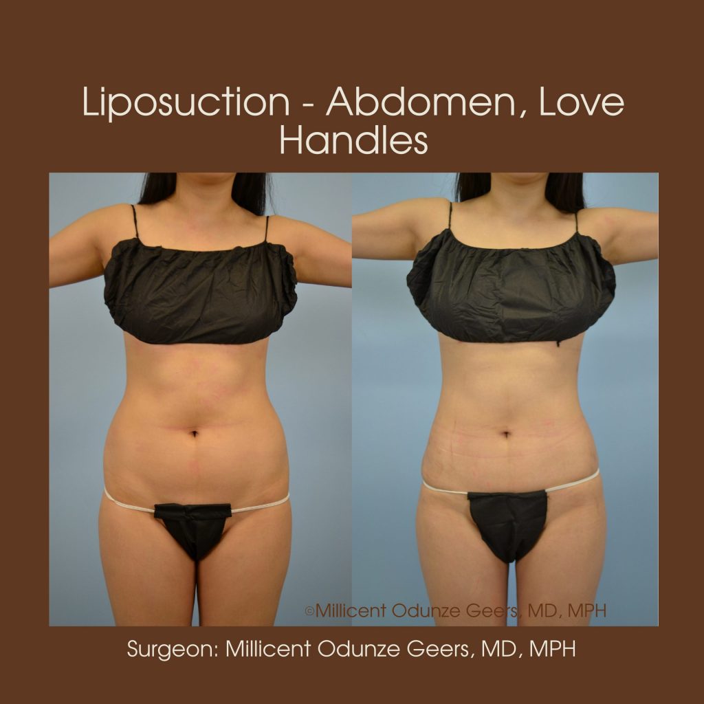 Best Colorado Springs Liposuction of Abdomen, Love Handles, Flanks