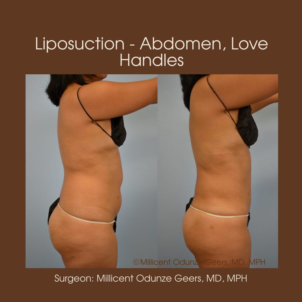 Best Colorado Springs Liposuction of Abdomen, Love Handles, Flanks