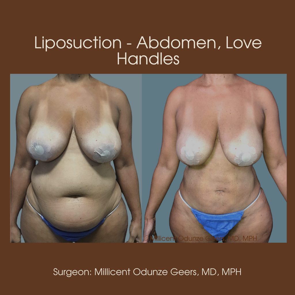 Best Colorado Springs Liposuction of Abdomen, Love Handles, Flanks