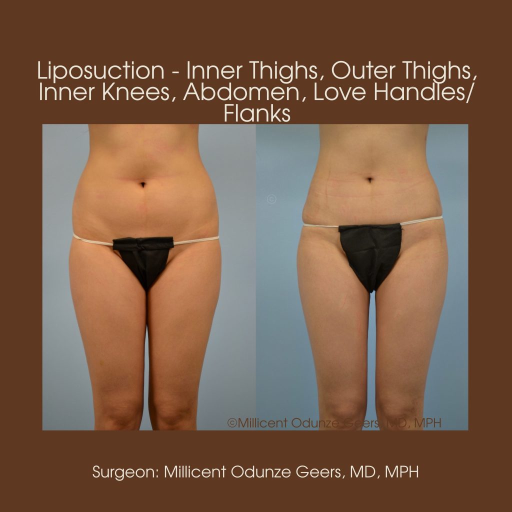 Best Colorado Springs Liposuction of Thighs