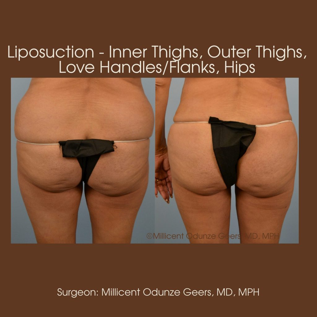 Best Colorado Springs Liposuction of Thighs