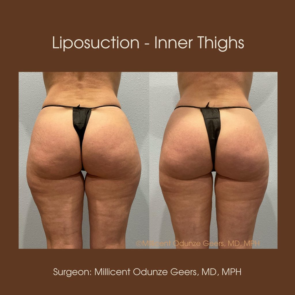 Best Colorado Springs Liposuction of Thighs