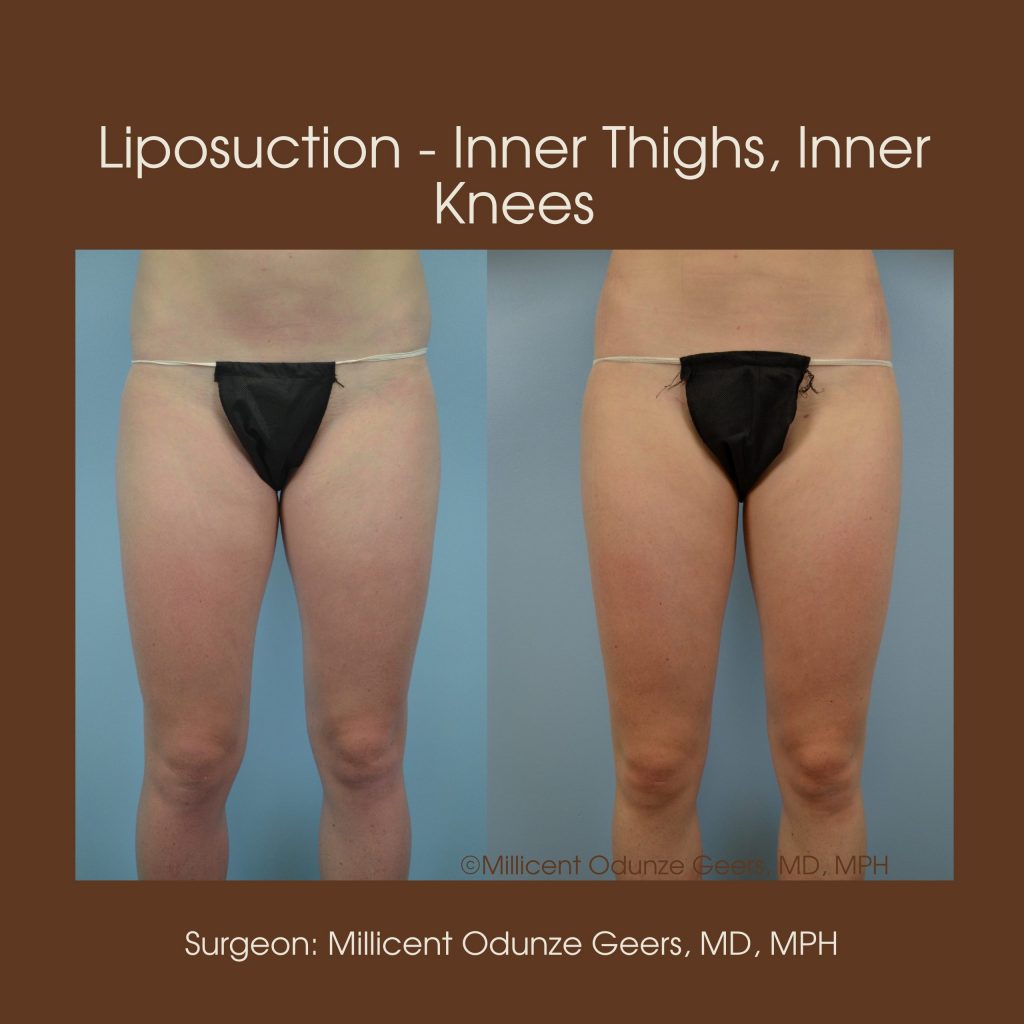 Liposuction of Thighs Colorado Springs