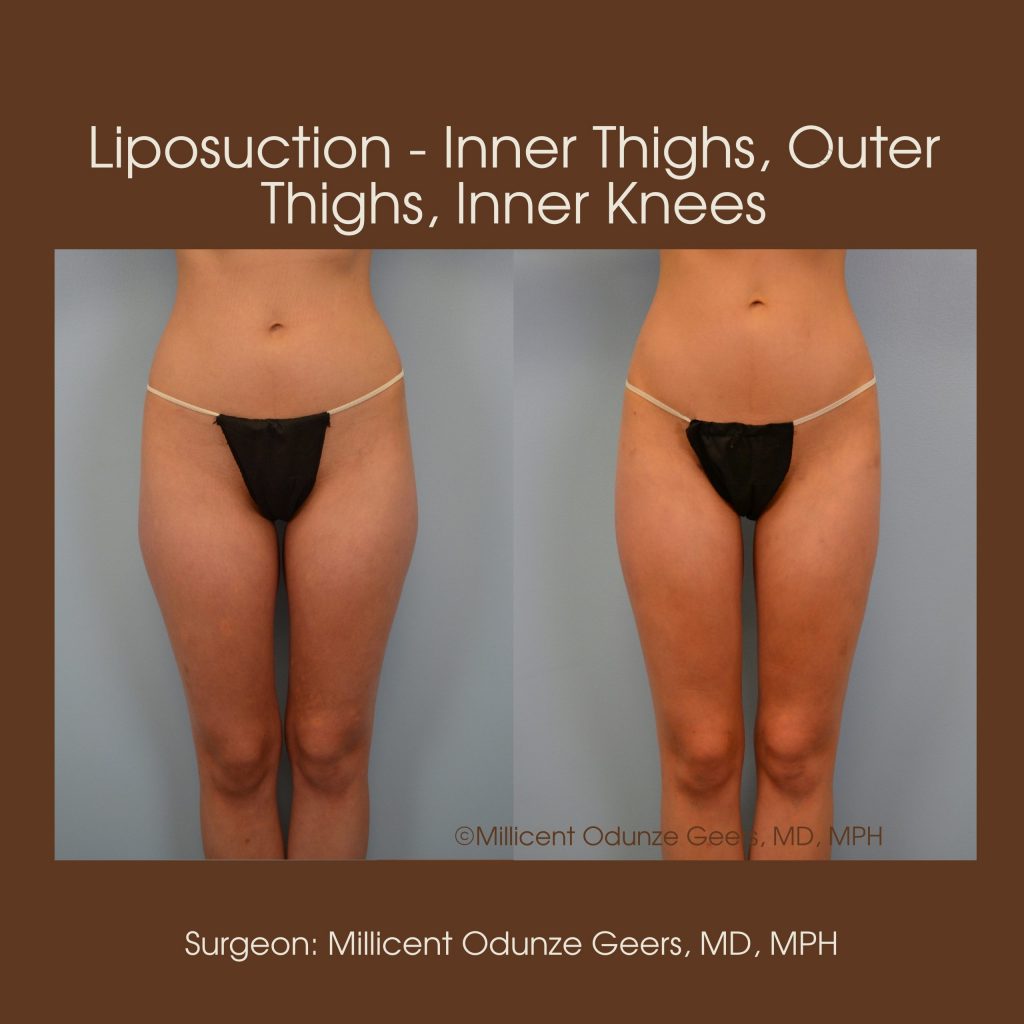 Best Colorado Springs Liposuction of Thighs