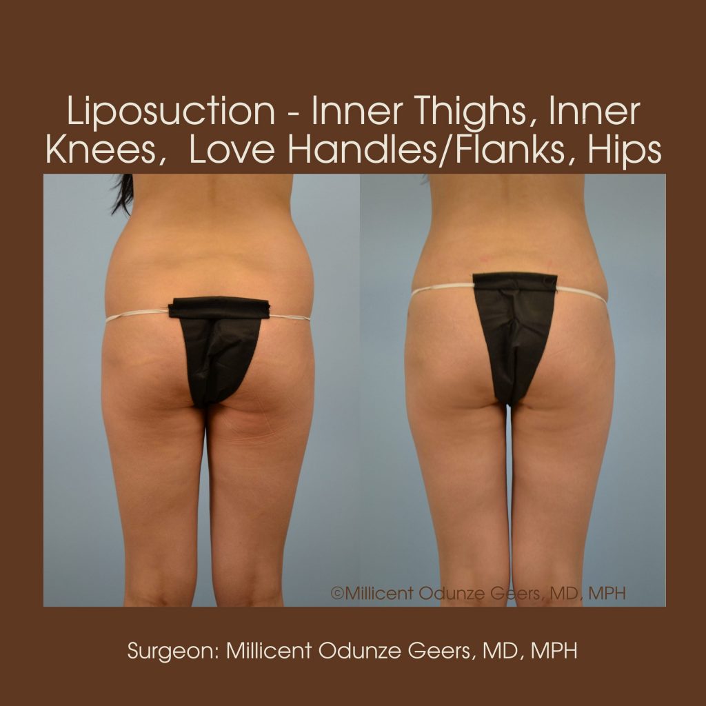 Best Colorado Springs Liposuction of Thighs