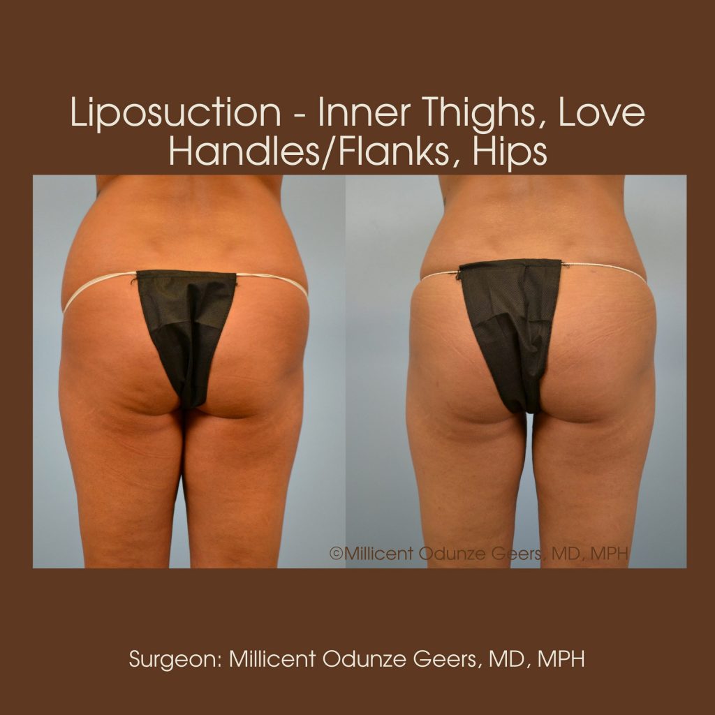 Best Colorado Springs Liposuction of Thighs