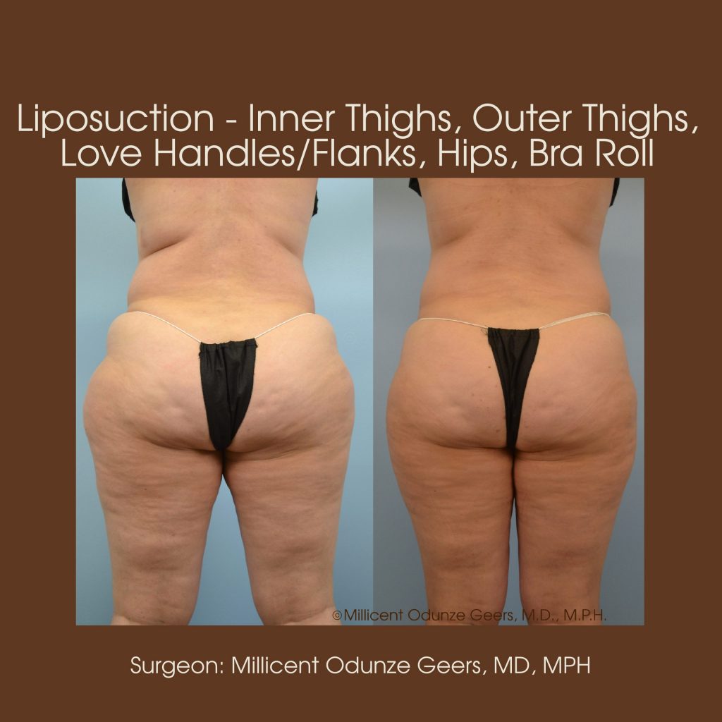 Best Colorado Springs Liposuction of Thighs